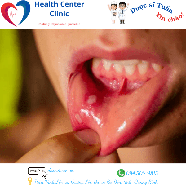 Hinh anh benh nhan bi loet mieng nho (nhiet mieng)